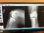 Knee Operation